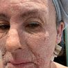 Mum left in agony and housebound after 40-year eczema treatment - now she&apos;s warning others