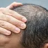 Doctor warns people to cut common lunch time drink that could cause hair loss
