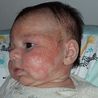 Eczema so bad baby looked like a burns victim until mum found answer
